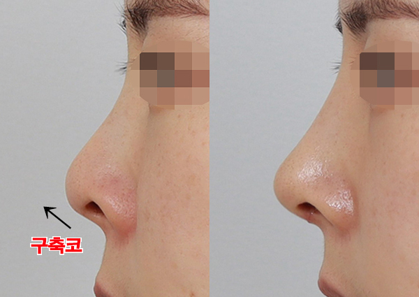  자가진피코성형, 자연스러운 결과로!(강남성형외과 치유)