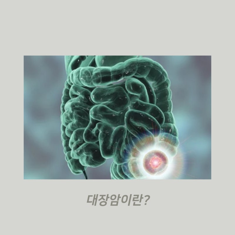 대장암 초기 증상 3기 4기 생존율(좋은 음식) : 네이버 블로그