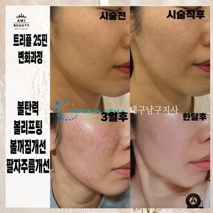  볼쳐짐.볼꺼짐.이중턱 고민이신분들 트리플플라즈마로 해결해드립니다 (대구아미뷰티)