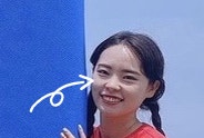  다크서클수술 (눈밑지방재배치+앞광대이식) 6개월 차 후기