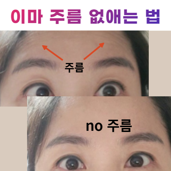  졸린 눈 선명하게 (이마 주름 없애는 운동)