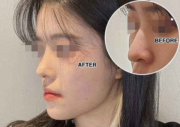  화살코성형, 긴코가 스트레스라면?!(치유성형외과 직반버선코 후기)