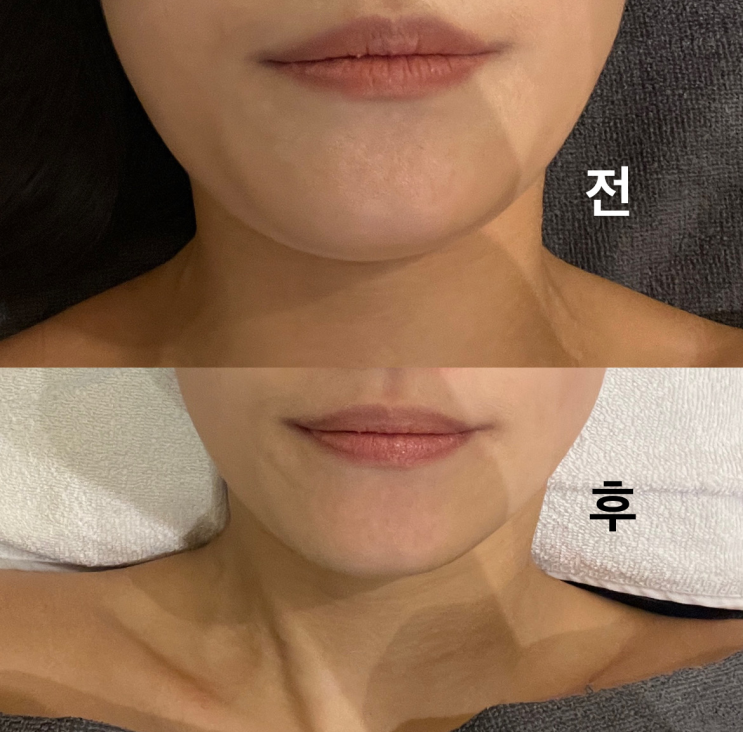  [부평피부관리] 부평 에스테틱 루미에르 에스테틱에서 하이푸 + 물방울 + 갈바닉 + 콜라겐 벨벳관리 마스크 받고 왔어요