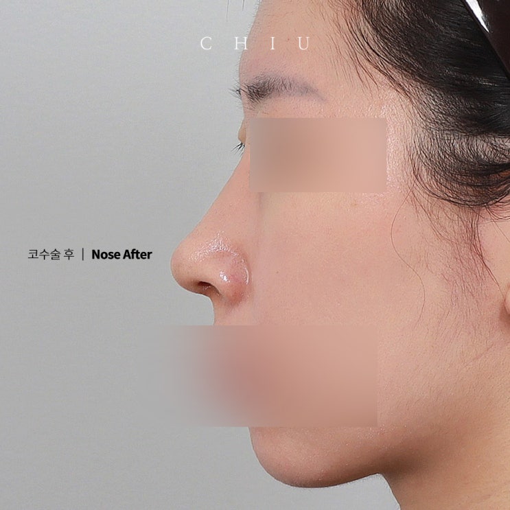  매부리코수술잘하는곳 찾고 있다면?!(서울성형외과)