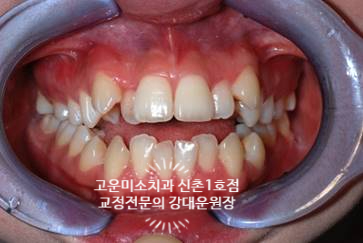  덧니가 있는 심한 개방교합 발치치료증례 신촌교정치과 교정전문의 강대운원장 고운미소신촌1호점 치료증례