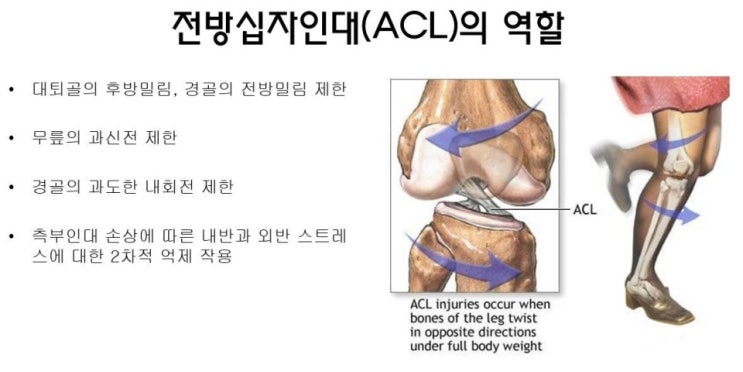 전방십자인대 손상 검사방법 및 치료방법