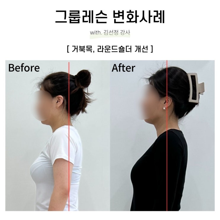  [대구SNPE 리셋바디] 거북목,라운드숄더 개선 회원님 비포에프터️