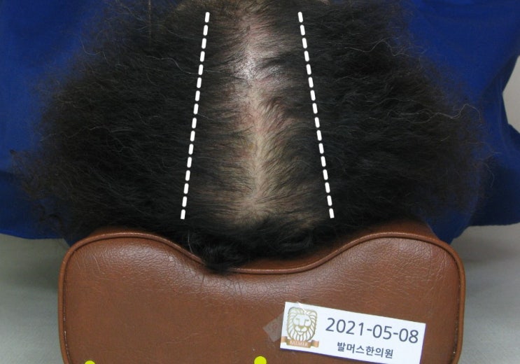  홍대 탈모치료 - 여자 정수리, 가르마 탈모의 치료 사례