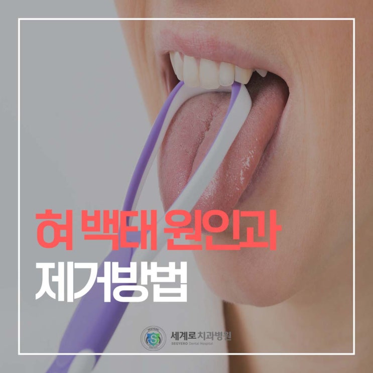  혀 백태가 생기는 원인과 제거 방법