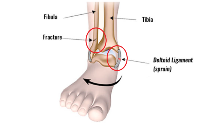 Kleiger’s test(external rotation test)/ 클레이거 검사/경비간인대, syndesmosis 검사 ...