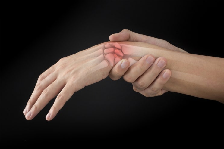 손목 골절 재활운동, 완벽한 회복을 위한 5가지 팁