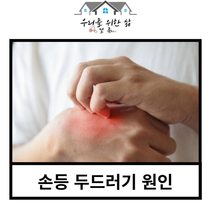 손등 두드러기 원인, 만성으로 발전하기 전에 파악하기