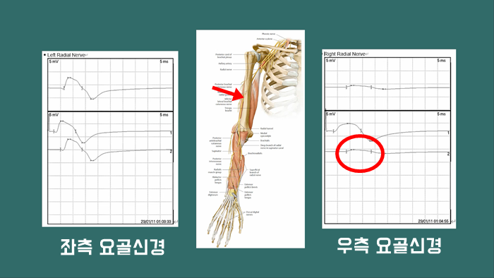 요골신경 마비의 진단과 치료[양호한 예후의 조건] : 네이버 블로그