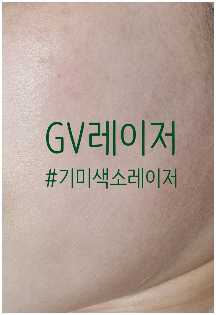 청담동피부과 기미잡티 없애기 비포에프터(GV레이저)