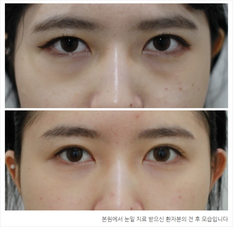 레이저 눈밑지방재배치 가격/비용요약