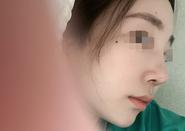  (휜코교정) 코 비대칭 있는데 코수술시 절골 필수일까요?ㅠㅜ