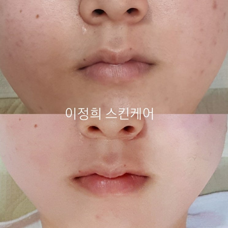  천안여드름흉터 :: 화농성 여드름 흉터 집중 관리 '이정희 스킨케어'