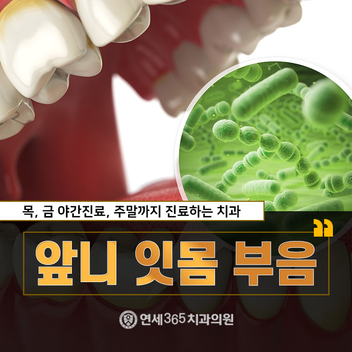  앞니잇몸부음 치석 제거가 중요