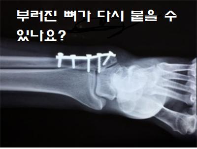  부러진 뼈가 다시 붙을 수 있나요