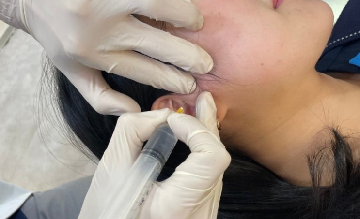 인천턱관절, 의외로 모르는 프롤로 주사 치료의 효능