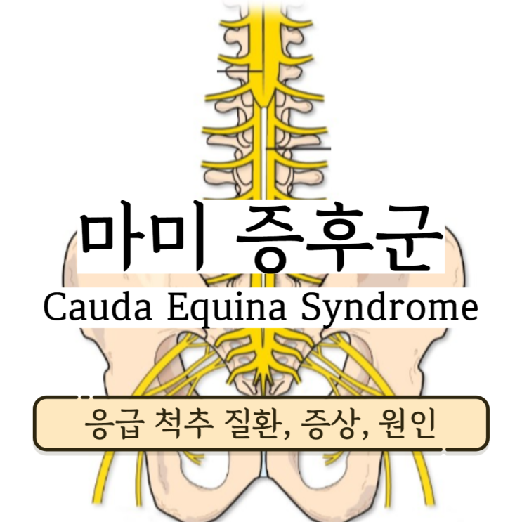 마미증후군 마미총증후군 증상 및 원인 (응급척추질환 허리디스크 대소변장애) 마미증후군 마미총증후군 증상 및 원인 (응급척추질환 허리디스크 대소변장애)