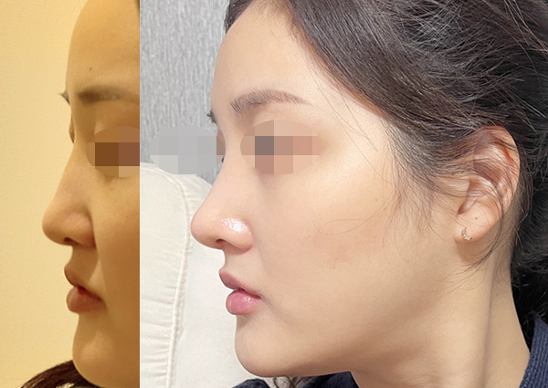  코끝수술, 콧대 보다 코끝을 더 중요시!!!(강남성형외과 치유)
