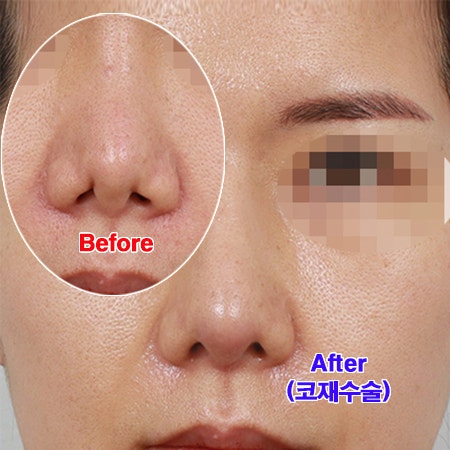  코재수술 / 첫코수술 실패 원인 파악 먼저 <코재수술에 대해>