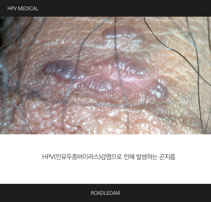 고환 피지낭종의 이해와 곤지름의 구별(ft. 가려움) : 네이버 블로그 고환 피지낭종의 이해와 곤지름의 구별(Ft. 가려움) : 네이버 블로그