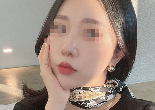  코수술 후 콧볼 패임, 흉살 ㅠㅠ 되돌릴 수 있나요?(복코교정)