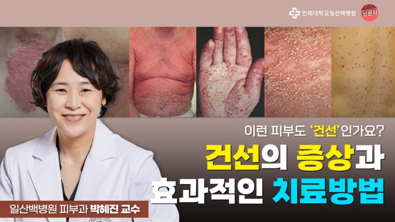 참을 수 없는 가려움 건선, 완치는 가능할까? / 일산백병원 피부과 박혜진 교수