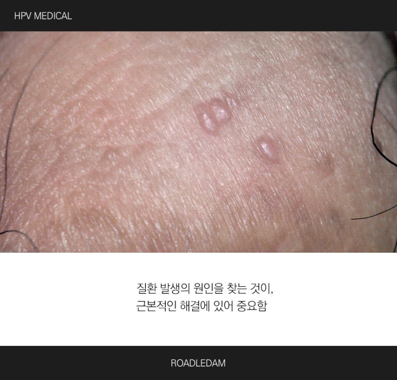 고환 피지낭종의 이해와 곤지름의 구별(ft. 가려움) : 네이버 블로그