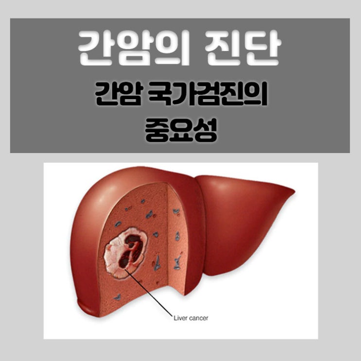  간세포암종(간암) 증례, 간암 국가검진의 중요성