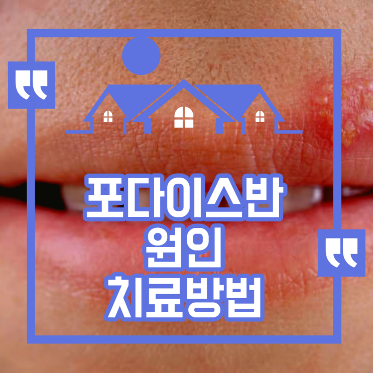 입술 포다이스반 하얀 점 원인  치료방법 알고 가세요