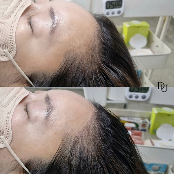  광주헤어라인문신 한 올 한 올 감쪽같아