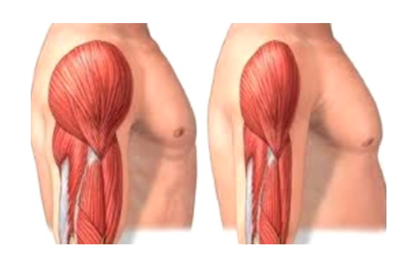  근감소증(Sarcopenia)과 비만(obesity)이 함께 있을 경우 신체기능 수준(SPPB)이 더욱 저조합니다 - 근감소성 비만(Sarcopenic obesity)