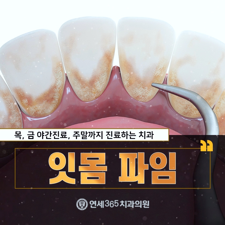  잇몸 파임 시린 느낌이 동반되나요