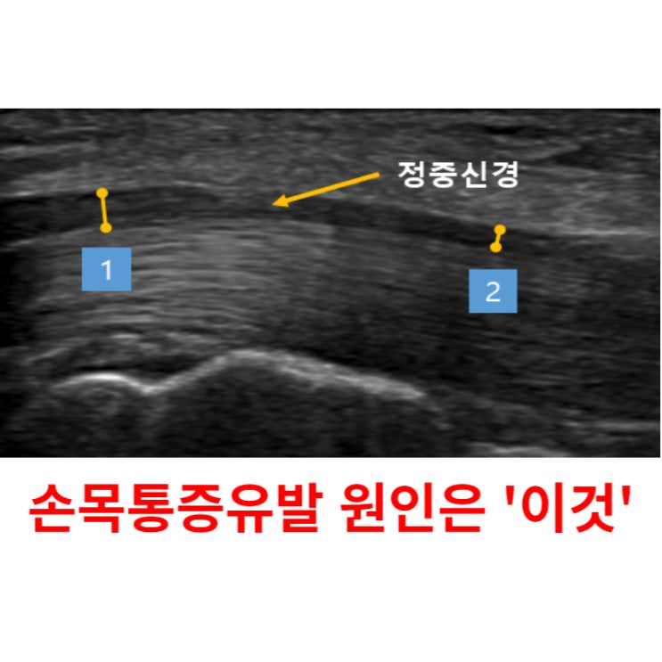  광주손목터널증후군, 통증 치료 '의사'가 직접 설명드립니다.