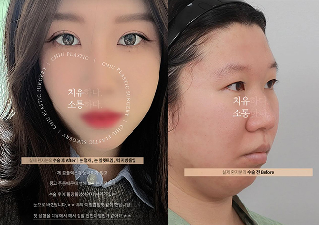  쌍꺼풀수술, 성공적(+이중턱지방흡입)치유성형외과 후기