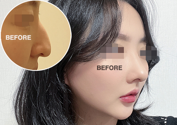  매부리코성형 후 인상이 부드러워졌어요!(압구정성형외과 치유)