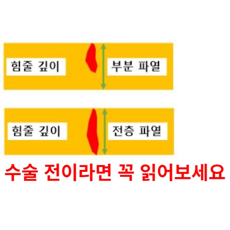  어깨힘줄 끊어짐, 수술 전 꼭 읽어보세요