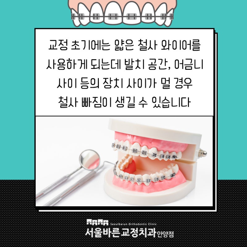 교정 철사 빠짐 원인 빠르게 대처해야 해요 : 네이버 블로그 교정 철사 빠짐 원인 빠르게 대처해야 해요 : 네이버 블로그