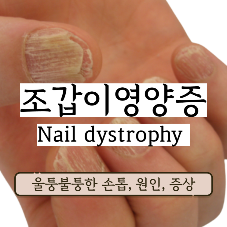 조갑이영양증 울퉁불퉁 줄무늬 손톱 발톱 원인 증상 진단 및 치료법 조갑이영양증 울퉁불퉁 줄무늬 손톱 발톱 원인 증상 진단 및 치료법