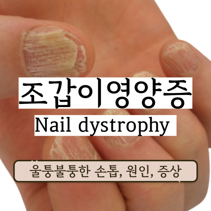 조갑이영양증 울퉁불퉁 줄무늬 손톱 발톱 원인 증상 진단 및 치료법