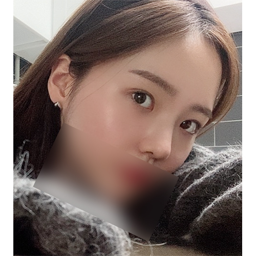  (눈,코성형)내가 가장 잘한 일 치유 성형외과 후기
