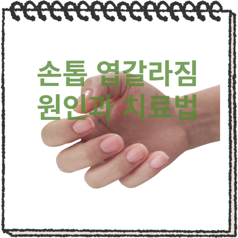 손톱 옆갈라짐 원인과 완화법 5가지