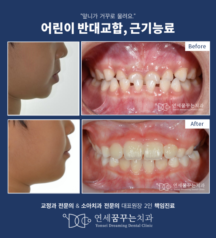 양평 어린이 반대교합, 부정교합 치료엔 근기능장치(프리올소) 양평 어린이 반대교합, 부정교합 치료엔 근기능장치(프리올소)