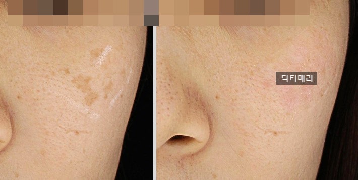 김포 블랙레드 제거? 고민하고 있다면 꼭 읽어야 할 글 김포 블랙레드 제거? 고민하고 있다면 꼭 읽어야 할 글