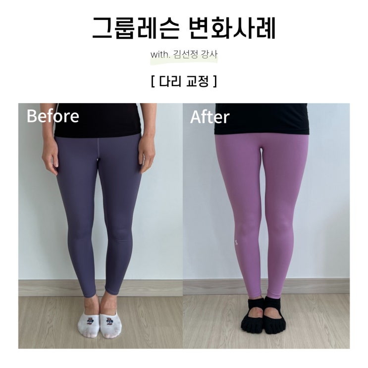  [대구SNPE 리셋바디] 리셋바디에서 SNPE 운동만으로 다리를 교정하신 회원님사례