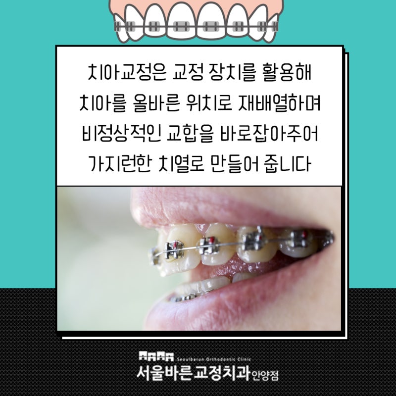 교정 철사 빠짐 원인 빠르게 대처해야 해요 : 네이버 블로그 교정 철사 빠짐 원인 빠르게 대처해야 해요 : 네이버 블로그