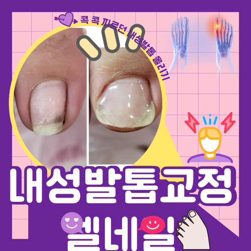 [전주.익산.군산내성발톱] 동글동글 말린 내성발톱~ 군산내성발톱전문샵 엘네일에서 3차내성....